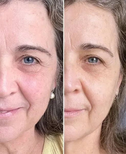 Aparelho rejuvenescedor: anti rugas e anti sinais